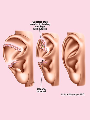 ear surgery new york