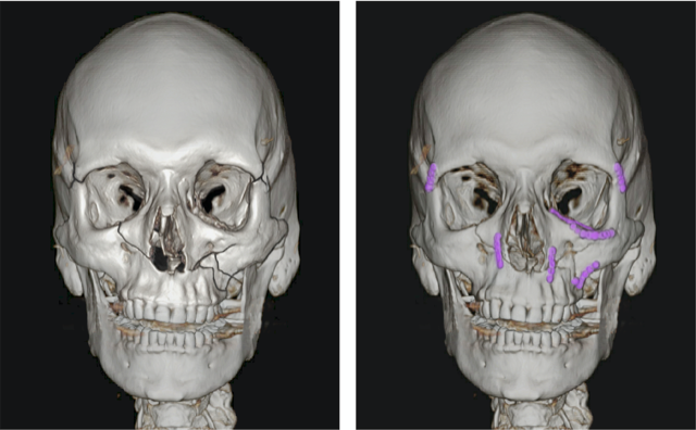 facial bone fractures new york