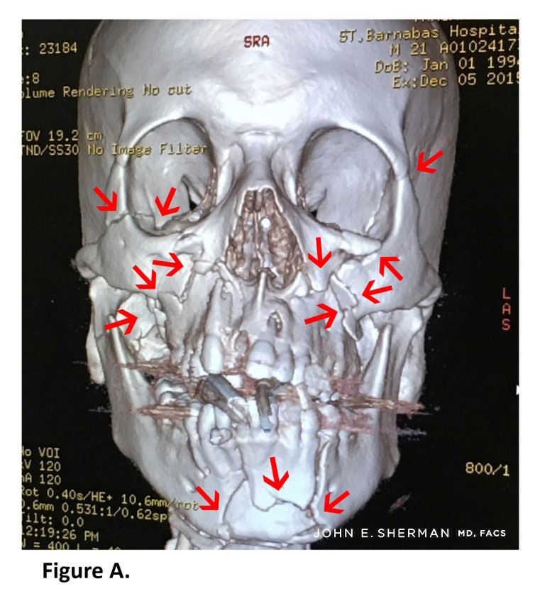 Complex Facial Fractures New York