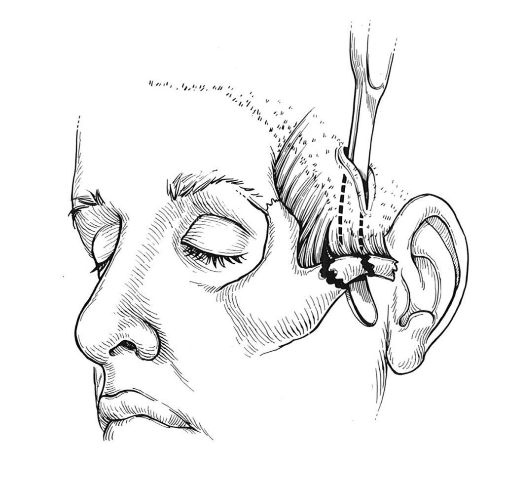 zygomatic arch fracture treatment