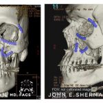 Facial Bone Fractures Before & After Patient #9396