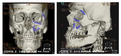 Facial Bone Fractures Before & After Patient #9396