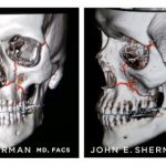 Facial Bone Fractures Before & After Patient #9396