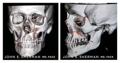 Facial Bone Fractures Before & After Patient #9396