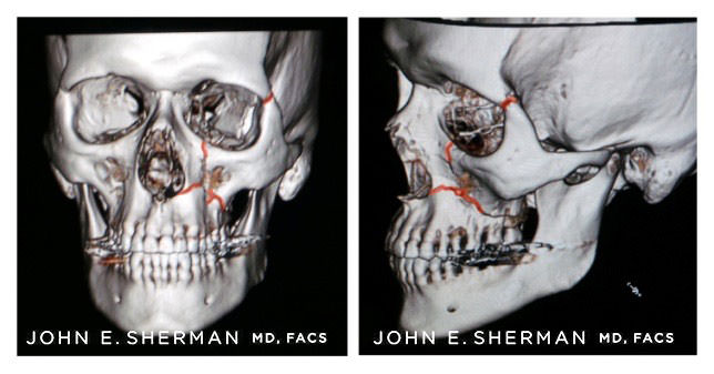 facial bone fractures new york