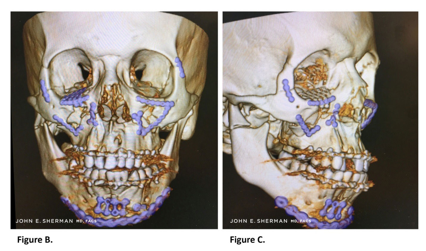 Complex Facial Fractures New York