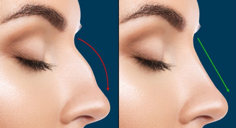 Rhinoplasty New York