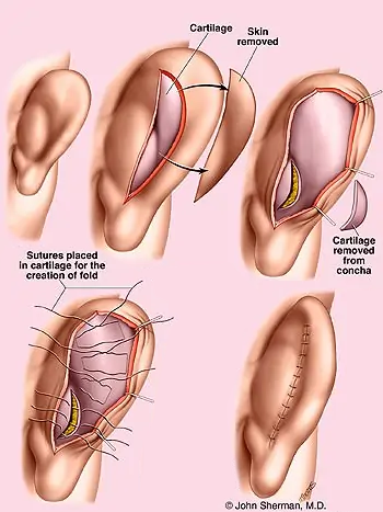 ear surgery new york