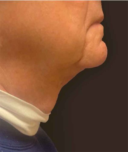 Neck Lift Before & After Patient #9516