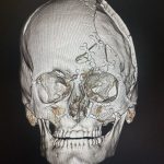 Complex Facial Fracture After Reconstructive Surgery Before & After Patient #9716