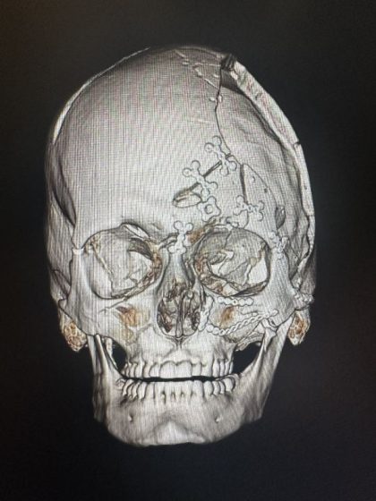 Complex Facial Fracture After Reconstructive Surgery Before & After Patient #9716