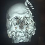 Complex Facial Fracture After Reconstructive Surgery Before & After Patient #9716