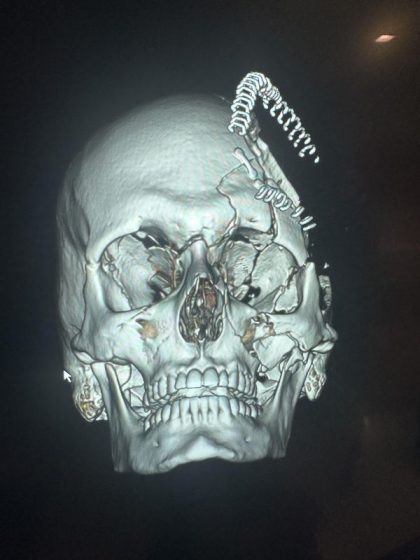 Complex Facial Fracture After Reconstructive Surgery Before & After Patient #9716